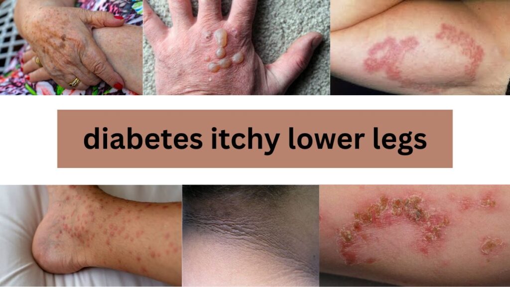Diabetes itchy lower legs