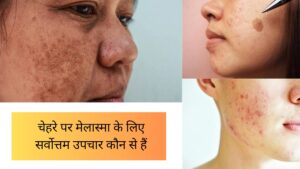 Melasma treatment in hindi