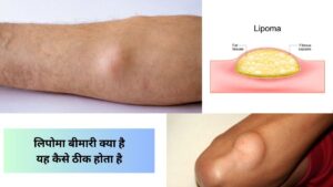 lipoma meaning in hindi